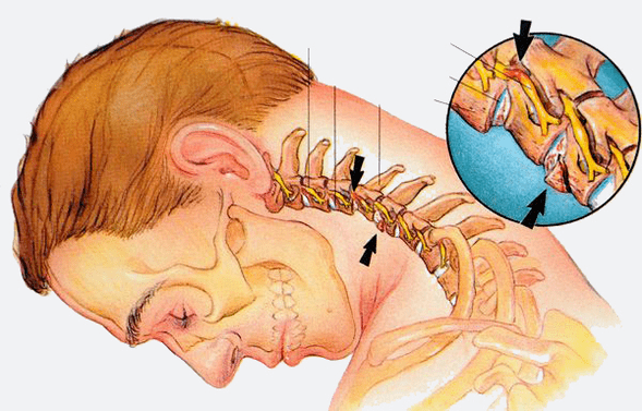 Stages of osteochondrosis of the cervical back